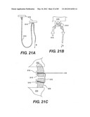 METHOD AND APPARATUS FOR THE TREATMENT OF THE INTERVERTEBRAL DISC ANNULUS diagram and image