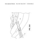 METHOD AND APPARATUS FOR THE TREATMENT OF THE INTERVERTEBRAL DISC ANNULUS diagram and image