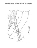 METHOD AND APPARATUS FOR THE TREATMENT OF THE INTERVERTEBRAL DISC ANNULUS diagram and image