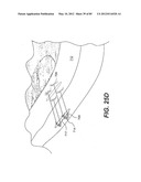 METHOD AND APPARATUS FOR THE TREATMENT OF THE INTERVERTEBRAL DISC ANNULUS diagram and image