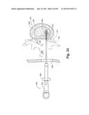 METHOD AND APPARATUS FOR THE TREATMENT OF THE INTERVERTEBRAL DISC ANNULUS diagram and image