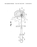 METHOD AND APPARATUS FOR THE TREATMENT OF THE INTERVERTEBRAL DISC ANNULUS diagram and image