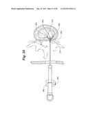 METHOD AND APPARATUS FOR THE TREATMENT OF THE INTERVERTEBRAL DISC ANNULUS diagram and image