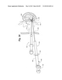 METHOD AND APPARATUS FOR THE TREATMENT OF THE INTERVERTEBRAL DISC ANNULUS diagram and image