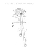 METHOD AND APPARATUS FOR THE TREATMENT OF THE INTERVERTEBRAL DISC ANNULUS diagram and image