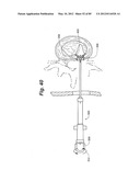 METHOD AND APPARATUS FOR THE TREATMENT OF THE INTERVERTEBRAL DISC ANNULUS diagram and image