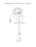 METHOD AND APPARATUS FOR THE TREATMENT OF THE INTERVERTEBRAL DISC ANNULUS diagram and image