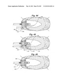 METHOD AND APPARATUS FOR THE TREATMENT OF THE INTERVERTEBRAL DISC ANNULUS diagram and image