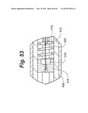 METHOD AND APPARATUS FOR THE TREATMENT OF THE INTERVERTEBRAL DISC ANNULUS diagram and image