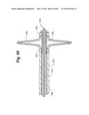 METHOD AND APPARATUS FOR THE TREATMENT OF THE INTERVERTEBRAL DISC ANNULUS diagram and image