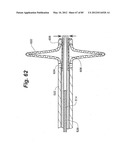 METHOD AND APPARATUS FOR THE TREATMENT OF THE INTERVERTEBRAL DISC ANNULUS diagram and image