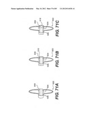 METHOD AND APPARATUS FOR THE TREATMENT OF THE INTERVERTEBRAL DISC ANNULUS diagram and image