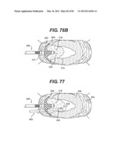 METHOD AND APPARATUS FOR THE TREATMENT OF THE INTERVERTEBRAL DISC ANNULUS diagram and image