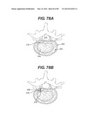 METHOD AND APPARATUS FOR THE TREATMENT OF THE INTERVERTEBRAL DISC ANNULUS diagram and image