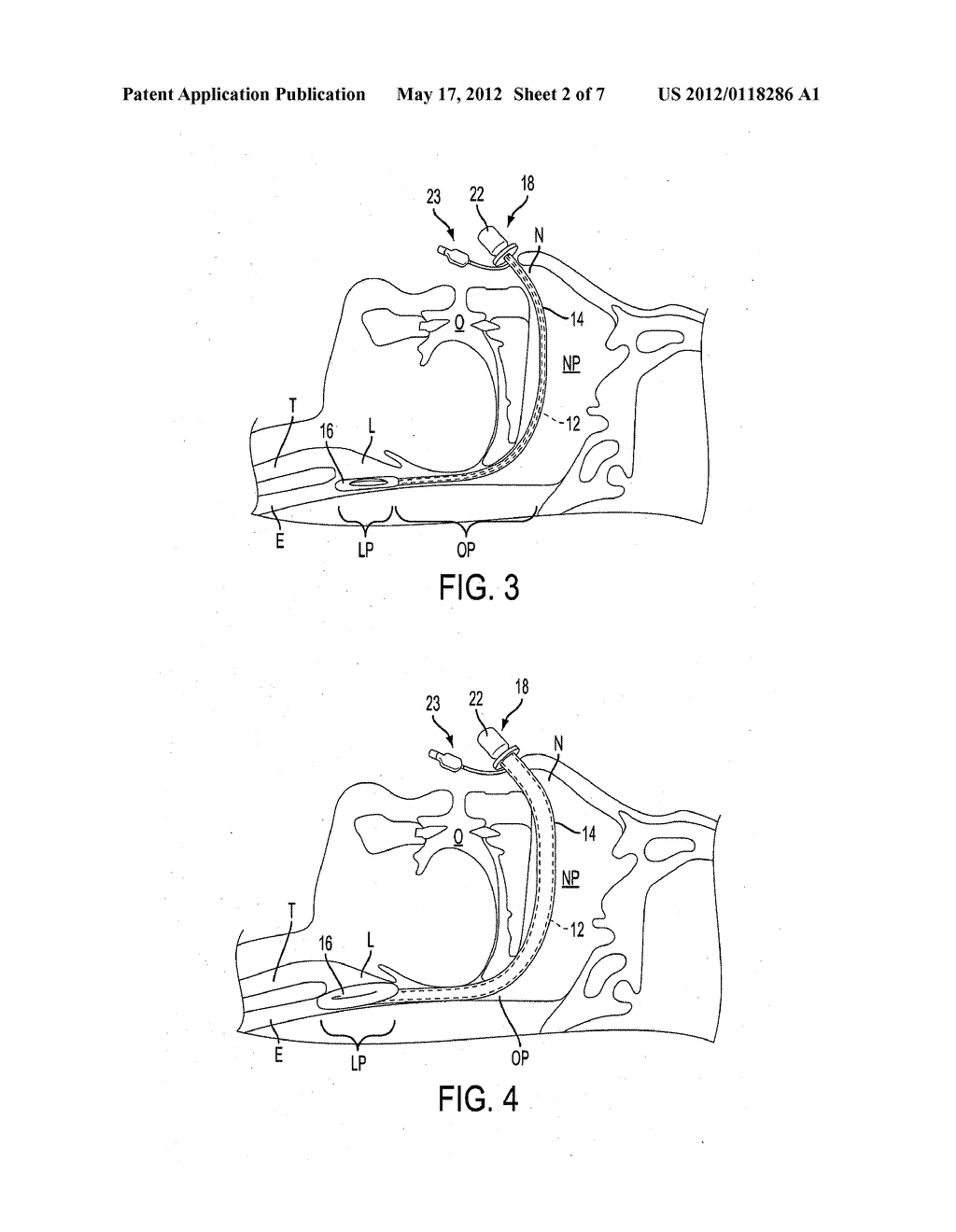 NASAL AIRWAY MANAGEMENT DEVICE - diagram, schematic, and image 03