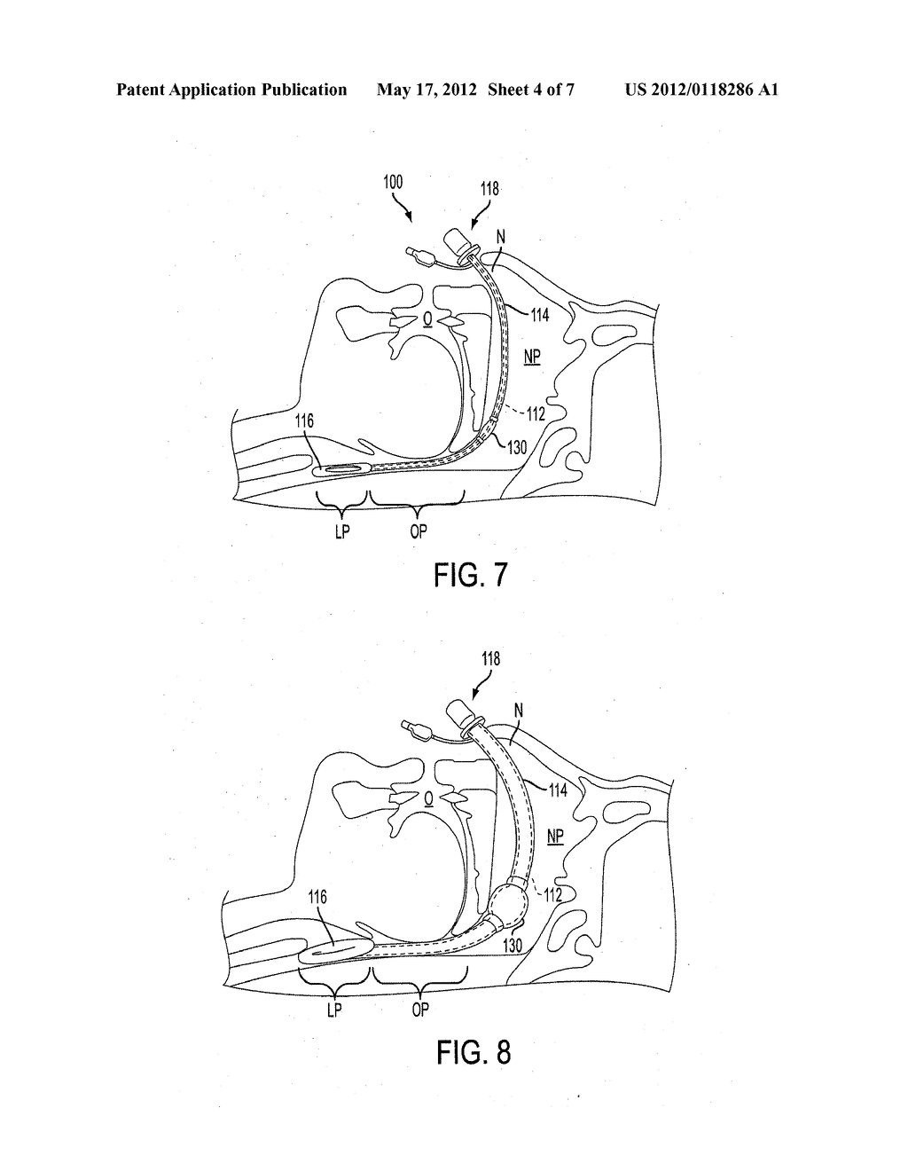 NASAL AIRWAY MANAGEMENT DEVICE - diagram, schematic, and image 05