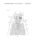 DENTAL IMPLANT diagram and image