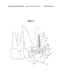 DENTAL IMPLANT diagram and image