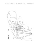 DENTAL IMPLANT diagram and image