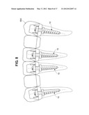 DENTAL IMPLANT diagram and image