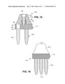 DENTAL IMPLANT diagram and image