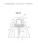 DENTAL IMPLANT diagram and image