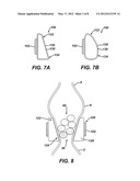 GASTRIC BAND WITH ASYMMETRICAL MEMBER diagram and image