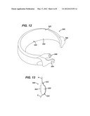 GASTRIC BAND WITH ASYMMETRICAL MEMBER diagram and image