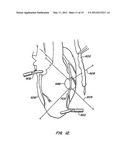 STABILIZER FOR ROBOTIC BEATING-HEART SURGERY diagram and image