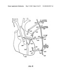 STABILIZER FOR ROBOTIC BEATING-HEART SURGERY diagram and image
