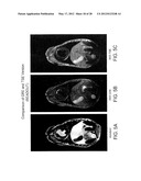 DARK BLOOD DELAYED ENHANCEMENT MAGNETIC RESONANCE VIABILITY IMAGING     TECHNIQUES FOR ASSESSING SUBENDOCARDIAL INFARCTS diagram and image
