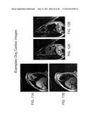 DARK BLOOD DELAYED ENHANCEMENT MAGNETIC RESONANCE VIABILITY IMAGING     TECHNIQUES FOR ASSESSING SUBENDOCARDIAL INFARCTS diagram and image