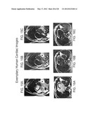 DARK BLOOD DELAYED ENHANCEMENT MAGNETIC RESONANCE VIABILITY IMAGING     TECHNIQUES FOR ASSESSING SUBENDOCARDIAL INFARCTS diagram and image