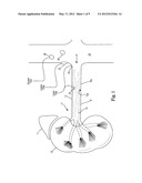 Renal Nerve Ablation Using Mild Freezing and Vibration diagram and image