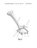 MALLEOLAR REGISTRATION CLAMP AND MALLEOLAR REGISTRATION METHOD diagram and image