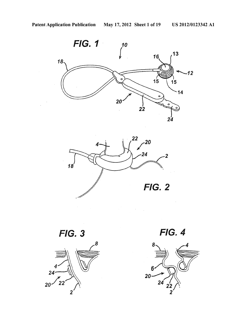 IMPLANTABLE INJECTION PORT WITH TISSUE IN-GROWTH PROMOTER - diagram, schematic, and image 02