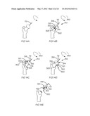 POSITIONING GUIDE AND BONE CUTTING GUIDE SYSTEM diagram and image