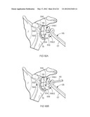 POSITIONING GUIDE AND BONE CUTTING GUIDE SYSTEM diagram and image