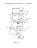 SPINAL IMPLANT AND METHOD FOR RESTRICTING SPINAL FLEXION diagram and image