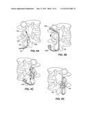 SPINAL IMPLANT AND METHOD FOR RESTRICTING SPINAL FLEXION diagram and image