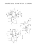 Ulna Osteotomy System diagram and image