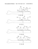 Ulna Osteotomy System diagram and image