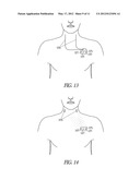 SYSTEM FOR ABATING NEURAL STIMULATION SIDE EFFECTS diagram and image