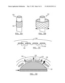 SYSTEM AND METHOD FOR REMOVING AN IMPLANTED OBJECT IN A PASSAGEWAY IN A     PATIENT diagram and image