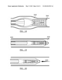 SYSTEM AND METHOD FOR REMOVING AN IMPLANTED OBJECT IN A PASSAGEWAY IN A     PATIENT diagram and image