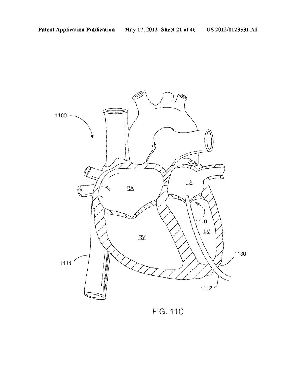 PERCUTANEOUS TRANSCATHETER REPAIR OF HEART VALVES - diagram, schematic, and image 22