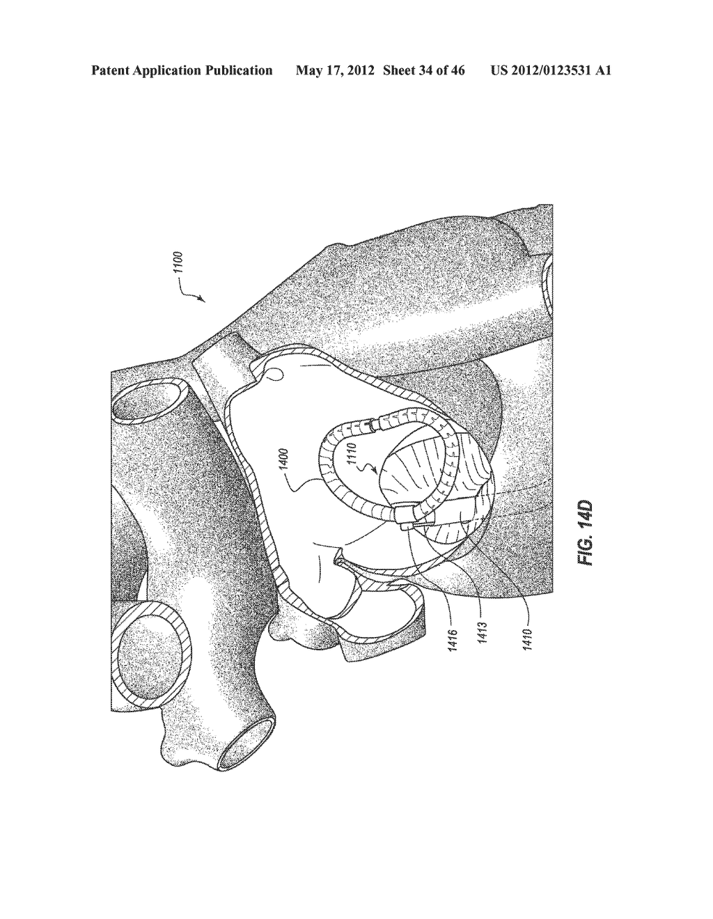 PERCUTANEOUS TRANSCATHETER REPAIR OF HEART VALVES - diagram, schematic, and image 35