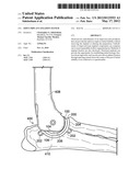 JOINT IMPLANT FIXATION SYSTEM diagram and image