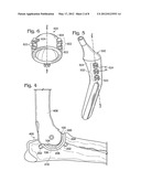 JOINT IMPLANT FIXATION SYSTEM diagram and image