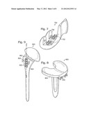 JOINT IMPLANT FIXATION SYSTEM diagram and image